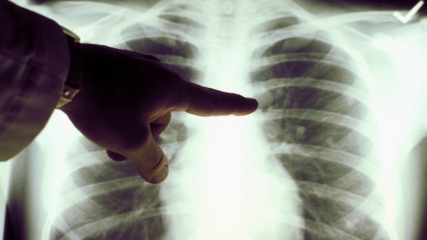 long-awaited-lung-cancer-screening-program-coming-to-pei.,-says-health-minister