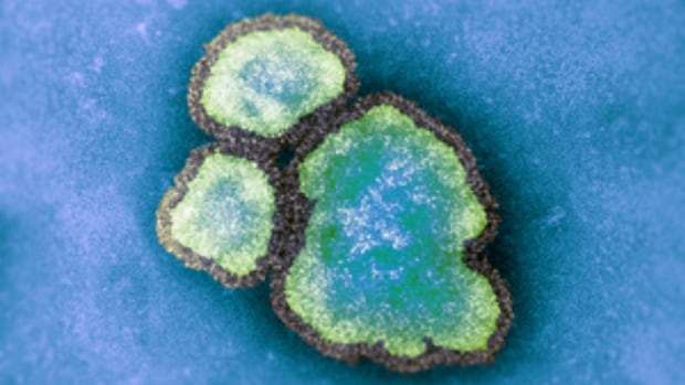 ontario-reports-over-100-new-measles-cases,-bringing-total-to-925