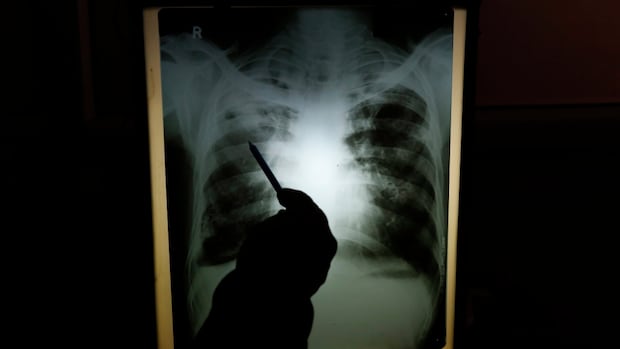 mobile-x-ray-program-being-brought-to-residents-of-pei.-long-term-care-homes