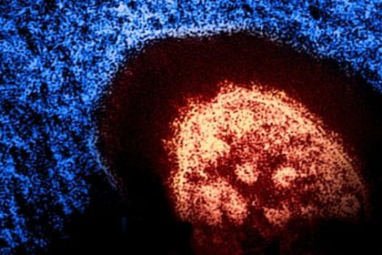 new-travel-related-measles-case-confirmed-in-bc.’s-lower-mainland