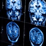 new-brunswick-has-no-mystery-neurological-disease,-scientific-study-concludes