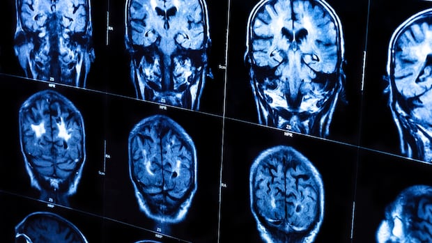 new-brunswick-has-no-mystery-neurological-disease,-scientific-study-concludes
