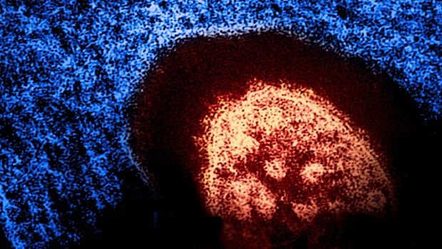 measles-may-be-circulating-in-small-northeast-bc.-community,-says-health-authority