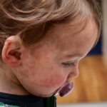 manitoba-reports-7-more-measles-cases-from-last-week