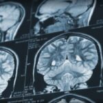patient-advocate-calls-for-retraction-of-mystery-brain-disease-report-from-us.-medical-journal
