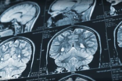 patient-advocate-calls-for-retraction-of-mystery-brain-disease-report-from-us.-medical-journal