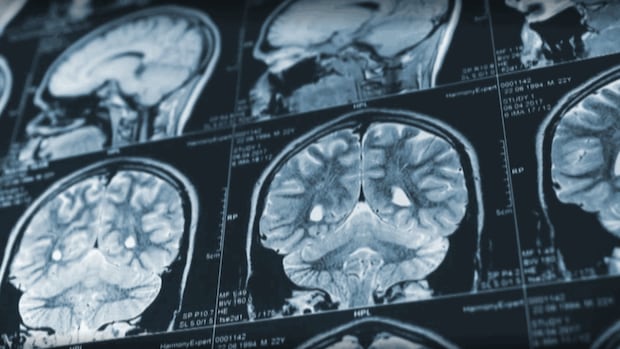 patient-advocate-calls-for-retraction-of-mystery-brain-disease-report-from-us.-medical-journal
