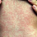 no-new-measles-cases-on-pei.-but-15-people-now-identified-as-being-at-risk,-cpho-says