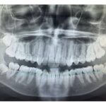 how-to-deal-with-wisdom-tooth-pain-and-surgical-removal