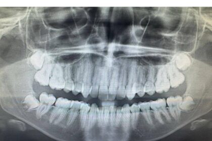 how-to-deal-with-wisdom-tooth-pain-and-surgical-removal