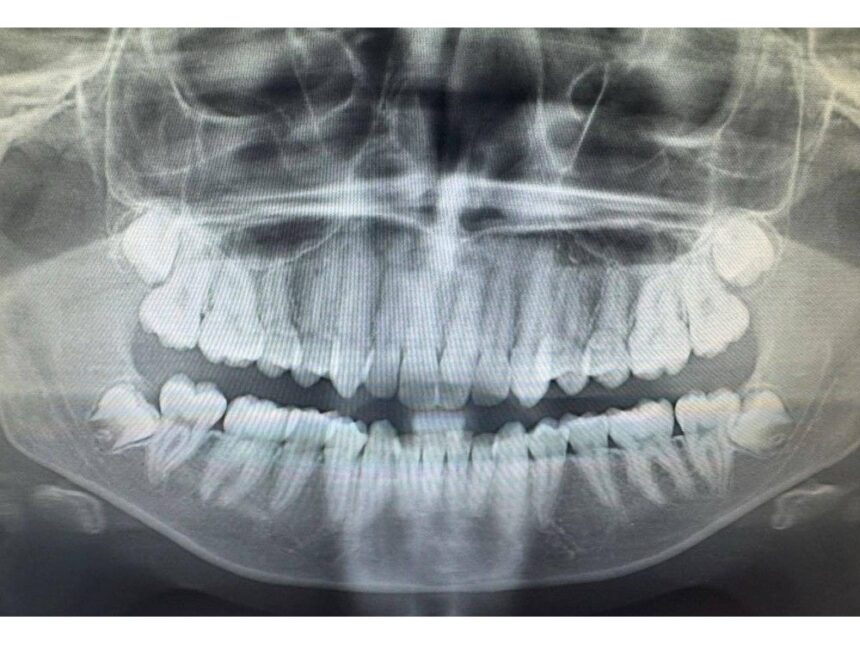 how-to-deal-with-wisdom-tooth-pain-and-surgical-removal