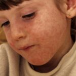 8-more-measles-cases-reported-in-manitoba,-bringing-total-to-116