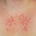 living-with-a-sun-allergy-can-be-‘absolutely-miserable,’-says-pei-woman