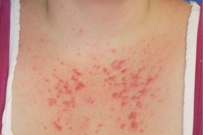 living-with-a-sun-allergy-can-be-‘absolutely-miserable,’-says-pei-woman