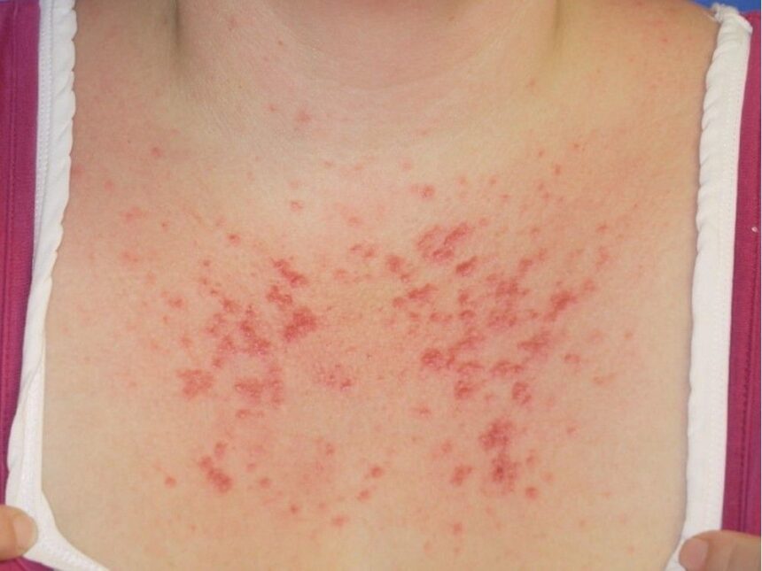 living-with-a-sun-allergy-can-be-‘absolutely-miserable,’-says-pei-woman