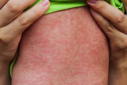 manitoba-warns-of-further-measles-exposure-at-winnipeg-children’s-hospital