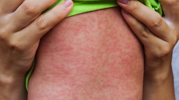 manitoba-warns-of-further-measles-exposure-at-winnipeg-children’s-hospital