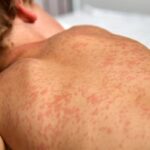 manitoba-health-warns-of-possible-measles-exposure-at-winkler-clinic-last-week