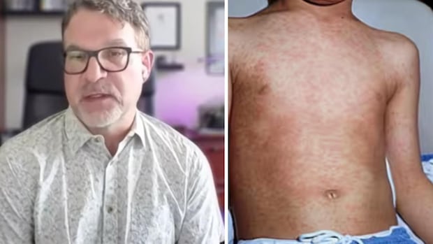 measles-spread-‘like-wildfire’-among-unvaccinated-children-in-northeast-bc.,-health-officer-says