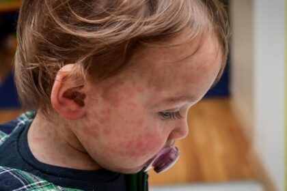 16-more-measles-cases-confirmed-in-manitoba,-bringing-total-to-146