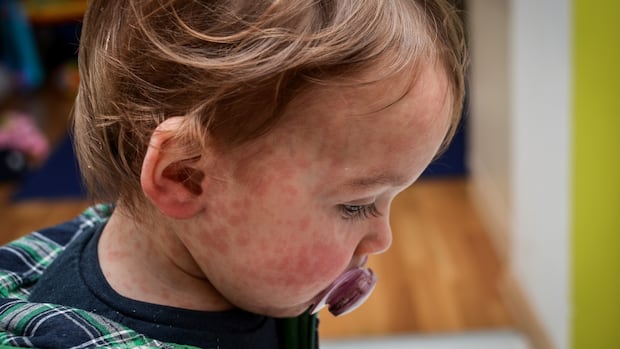 16-more-measles-cases-confirmed-in-manitoba,-bringing-total-to-146
