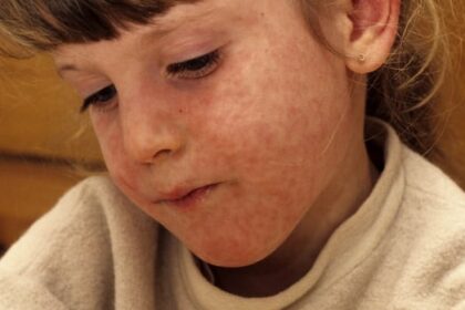 manitoba-warns-of-measles-exposure-in-portage-la-prairie-restaurant