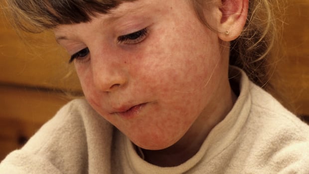 manitoba-warns-of-measles-exposure-in-portage-la-prairie-restaurant