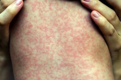2-new-exposure-sites-identified-as-measles-cluster-grows-in-ns.
