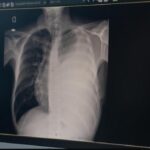 nunavik-tuberculosis-action-plan-to-be-finalized-in-coming-weeks,-says-health-ministry