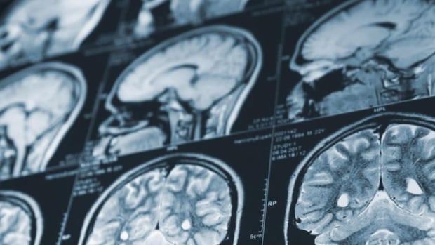 nb.-delays-report-on-mystery-brain-illness,-sends-all-data-for-federal-review
