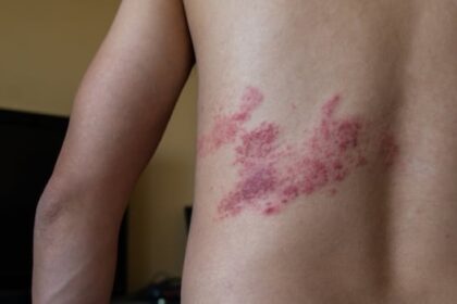 nb.-only-atlantic-province-without-shingles-vaccine-coverage