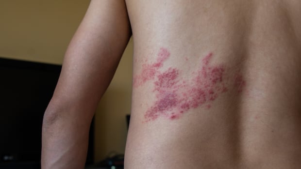 nb.-only-atlantic-province-without-shingles-vaccine-coverage