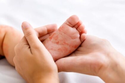 7-new-measles-cases-confirmed-in-manitoba,-provincial-health-officials-warn