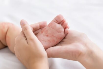manitoba-health-officials-confirm-9-more-measles-cases