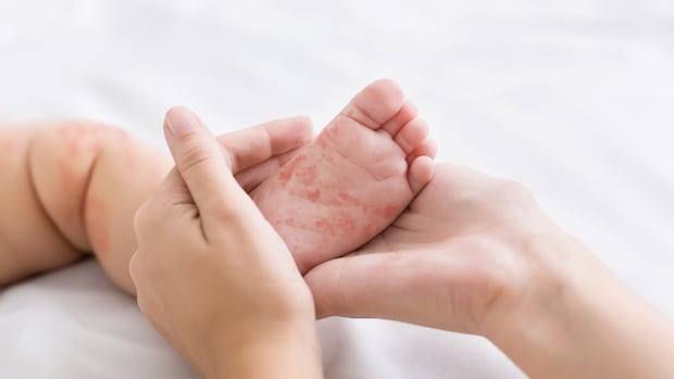 manitoba-health-officials-confirm-9-more-measles-cases