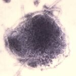 nearly-90%-of-manitoba’s-reported-measles-cases-involved-unvaccinated-patients:-public-health