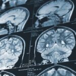 island-stroke-patients-to-be-part-of-worldwide-study-on-drug-that-busts-up-blood-clots