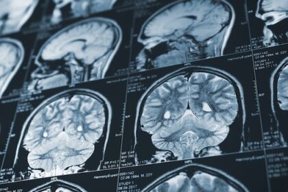 island-stroke-patients-to-be-part-of-worldwide-study-on-drug-that-busts-up-blood-clots