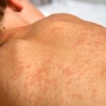winkler-school-latest-measles-exposure-site-in-manitoba