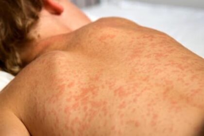 winkler-school-latest-measles-exposure-site-in-manitoba