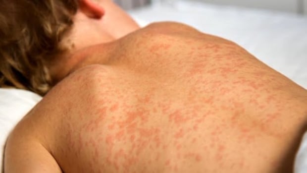 winkler-school-latest-measles-exposure-site-in-manitoba