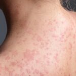 measles-exposure-at-southern-manitoba-truck-stop-restaurant-announced