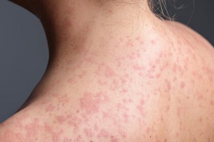 measles-exposure-at-southern-manitoba-truck-stop-restaurant-announced