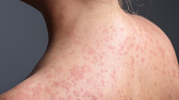 measles-exposure-at-southern-manitoba-truck-stop-restaurant-announced
