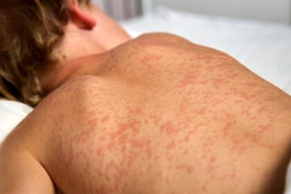 2-new-measles-cases,-1-exposure-reported-in-manitoba-ahead-of-the-weekend