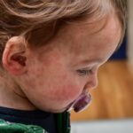 5-new-measles-exposure-sites-reported-in-winnipeg