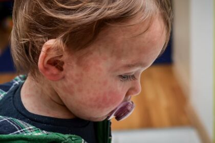 5-new-measles-exposure-sites-reported-in-winnipeg