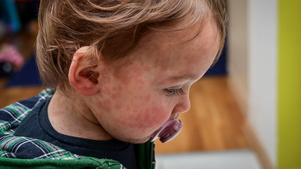 5-new-measles-exposure-sites-reported-in-winnipeg