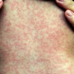 4-more-measles-cases,-1-new-exposure-site-confirmed-in-manitoba