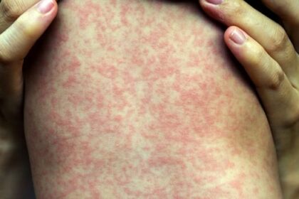 4-more-measles-cases,-1-new-exposure-site-confirmed-in-manitoba